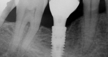 Dans quels cas a-t-on besoin d’un implant dentaire ?
