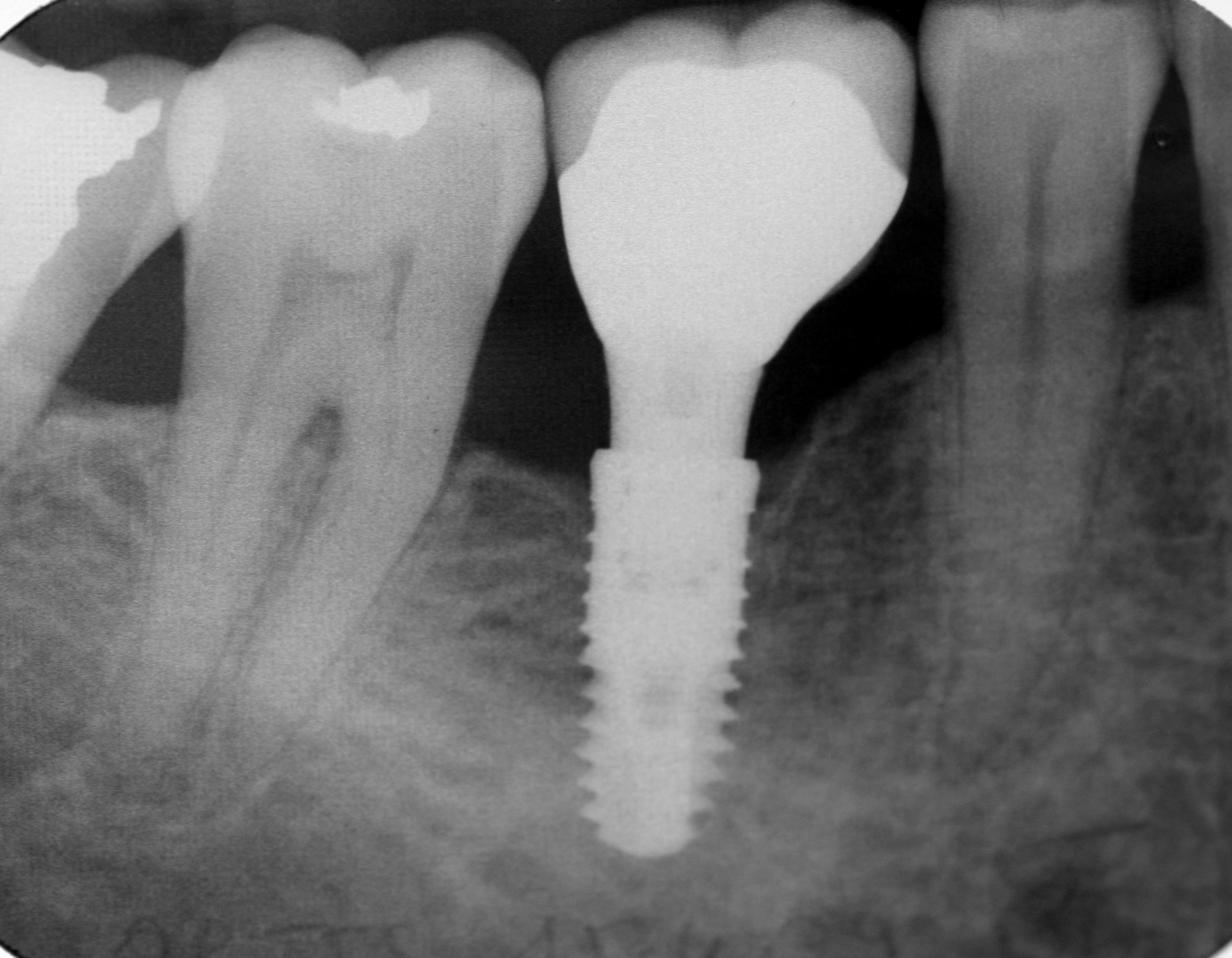 Dans quels cas a-t-on besoin d’un implant dentaire ?